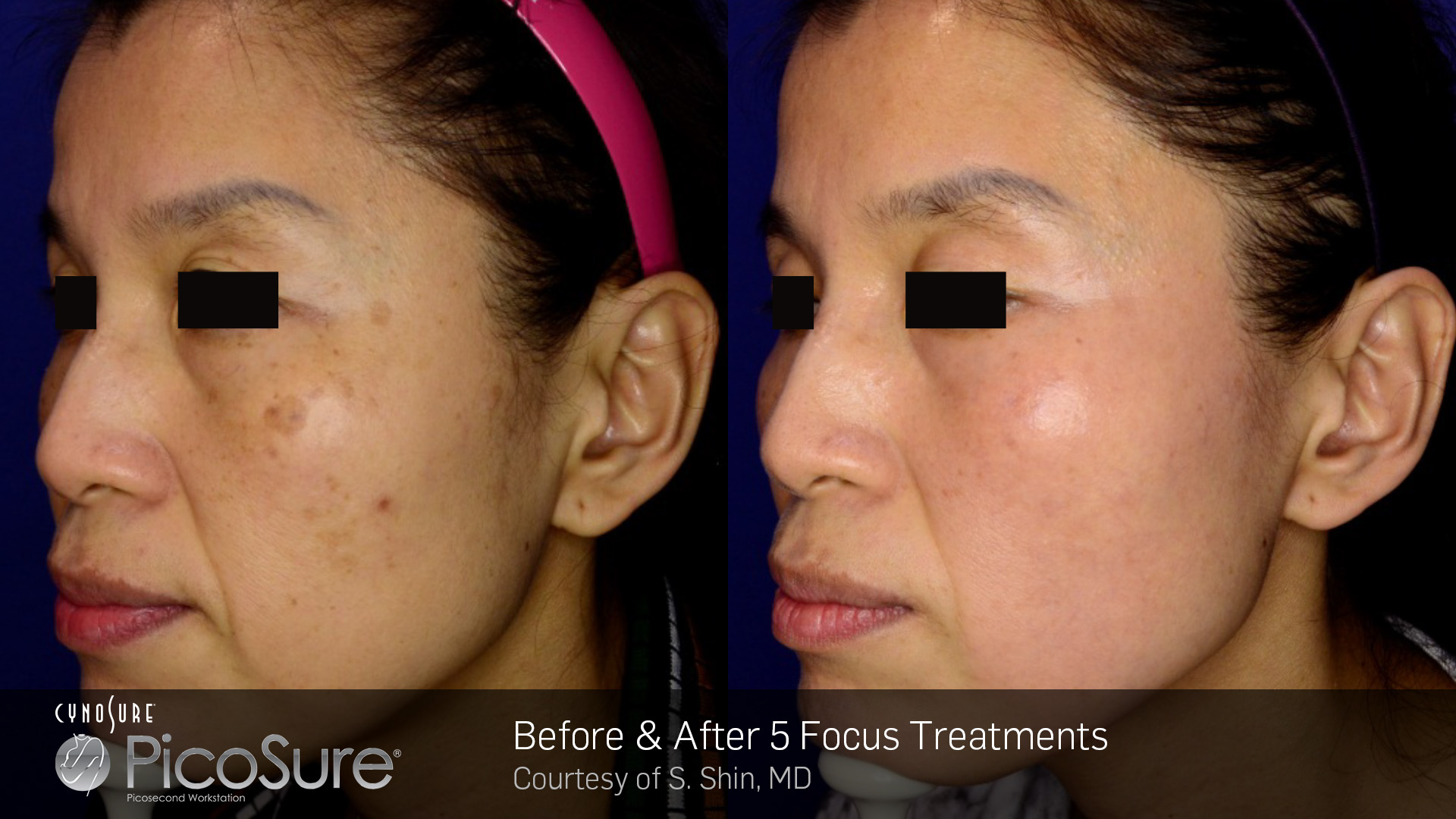 Laser Facial Before/After PicoSure Glasgow